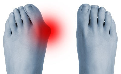 Wie entsteht ein Hallux valgus – und was kann man dagegen tun?